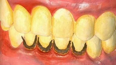 Жить здорово! Выпуск от 24.06.2013